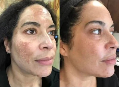 ARBUTIN WHITE ORIGINAL ✨ Sin Químicos Agresivos ✨